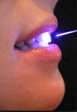 Il laser a diodo in odontoiatria e come ausilio del trattamento parodontale.